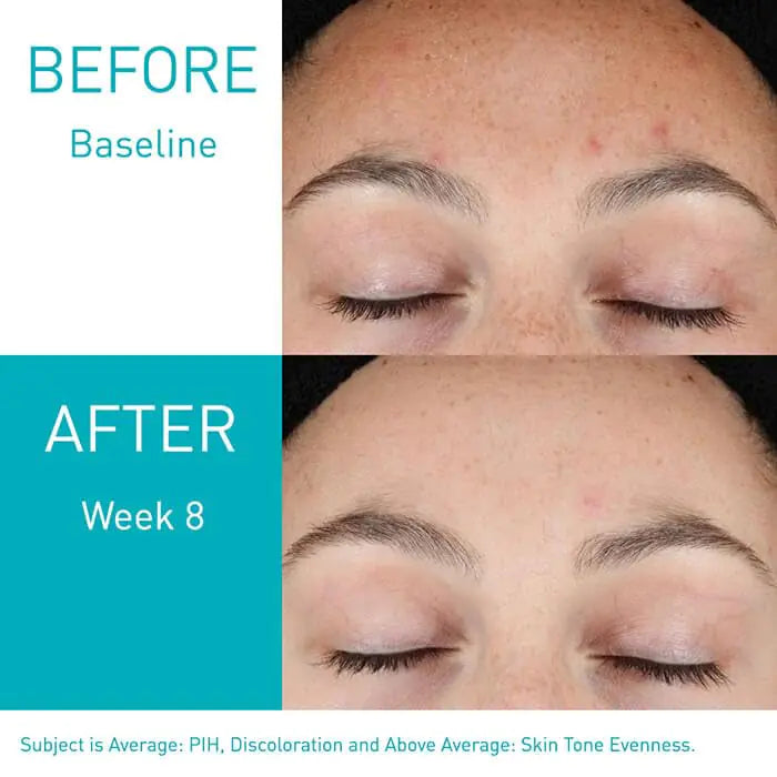 CERAVE Acne Treatment